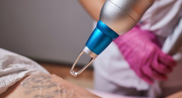Los 10 mejores centros para borrar tatuajes en CDMX